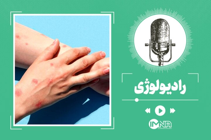 آشنایی با آبله میمونی + علایم و نحوه پیشگیری آشنایی با آبله میمونی + علایم و نحوه پیشگیری