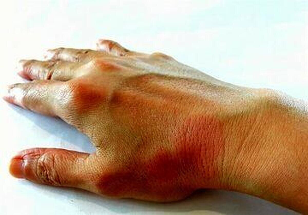 بهبود سریع زخمتوسط پروتئینهای شفابخش انگل روده