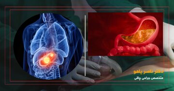آیا عمل اسلیو معده باعث سرطان میشود