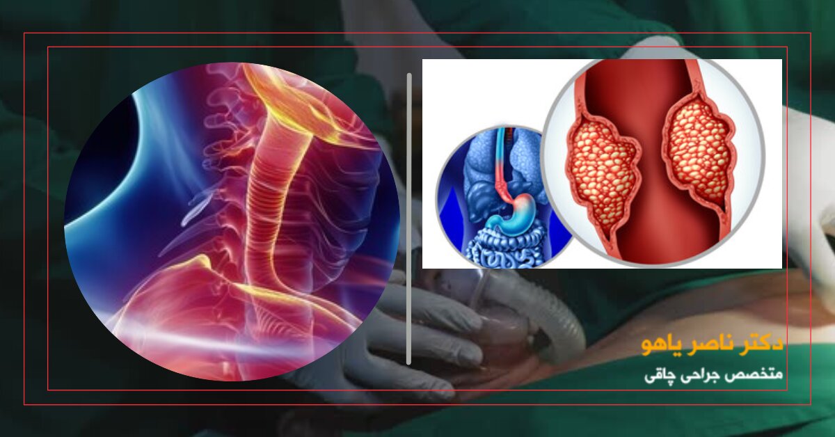 آیا عمل اسلیو معده باعث سرطان میشود