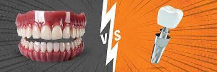 ایمپلنت یا دندان مصنوعی: کدام بهتر است؟ ایمپلنت یا دندان مصنوعی: کدام بهتر است؟