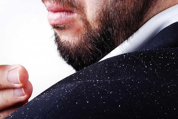 درمان خانگی شوره سر