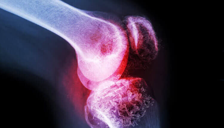 پوکی استخوان؛ نبردی بیصدا در معماری بدن