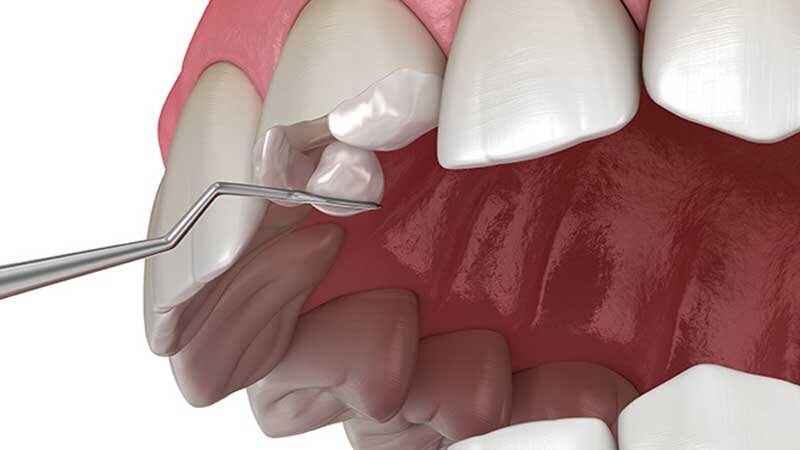 معرفی انواع کامپوزیت دندان + قیمت آنها