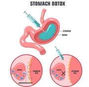 تزریق بوتاکس معده؛ بهترین روش لاغری و بدون جراحی