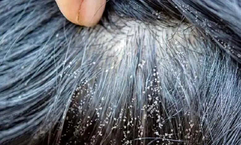 در صورت ابتلا به شپش سر چه اقداماتی باید انجام داد؟