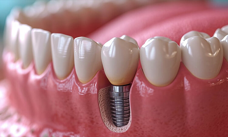 چرا ایمپلنت ایرانی میتواند جایگزین ایمپلنتهای خارجی شود؟