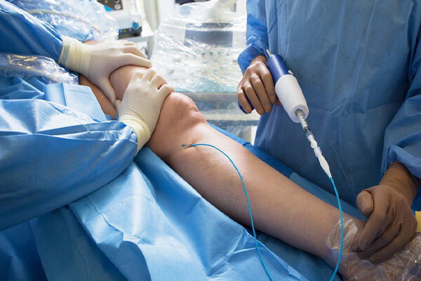 علت واریس پا چیست؟ چگونه درمان می شود؟ علت واریس پا چیست؟ چگونه درمان می شود؟