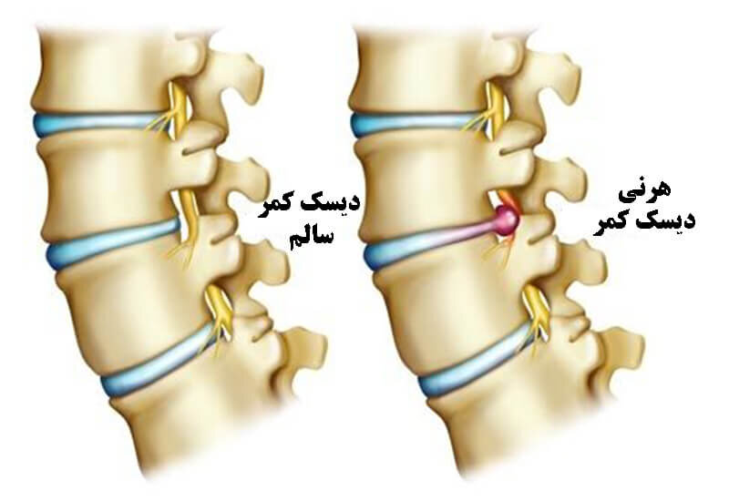 ۱۰ حرکت ورزش اصلاحی مفید دیسک کمر در خانه + علائم و روش درمان