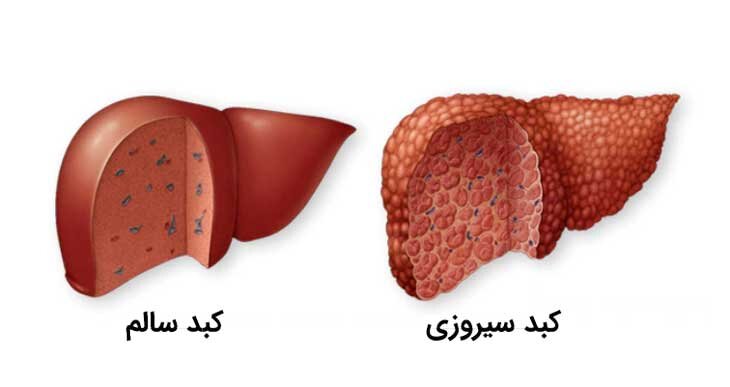 سیروز کبدی؛ قاتل خاموش سلامتی