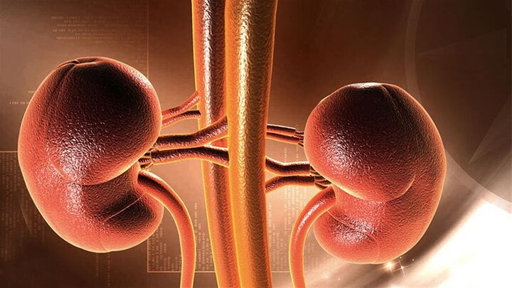 چالش‌های تغذیه‌ای مرتبط با سنگ‌های کلیوی