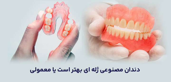 دندان مصنوعی ژله ای بهتر است یا معمولی دندان مصنوعی ژله ای بهتر است یا معمولی