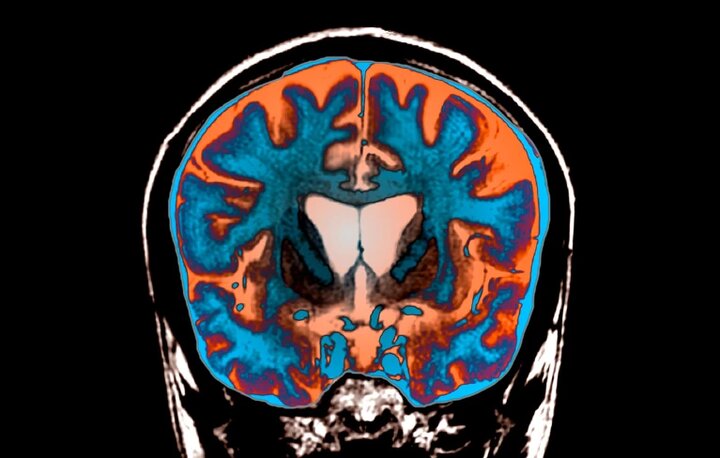 راز دیرینه هانتینگتون؛ چرا مغز دیر تسلیم می‌شود؟