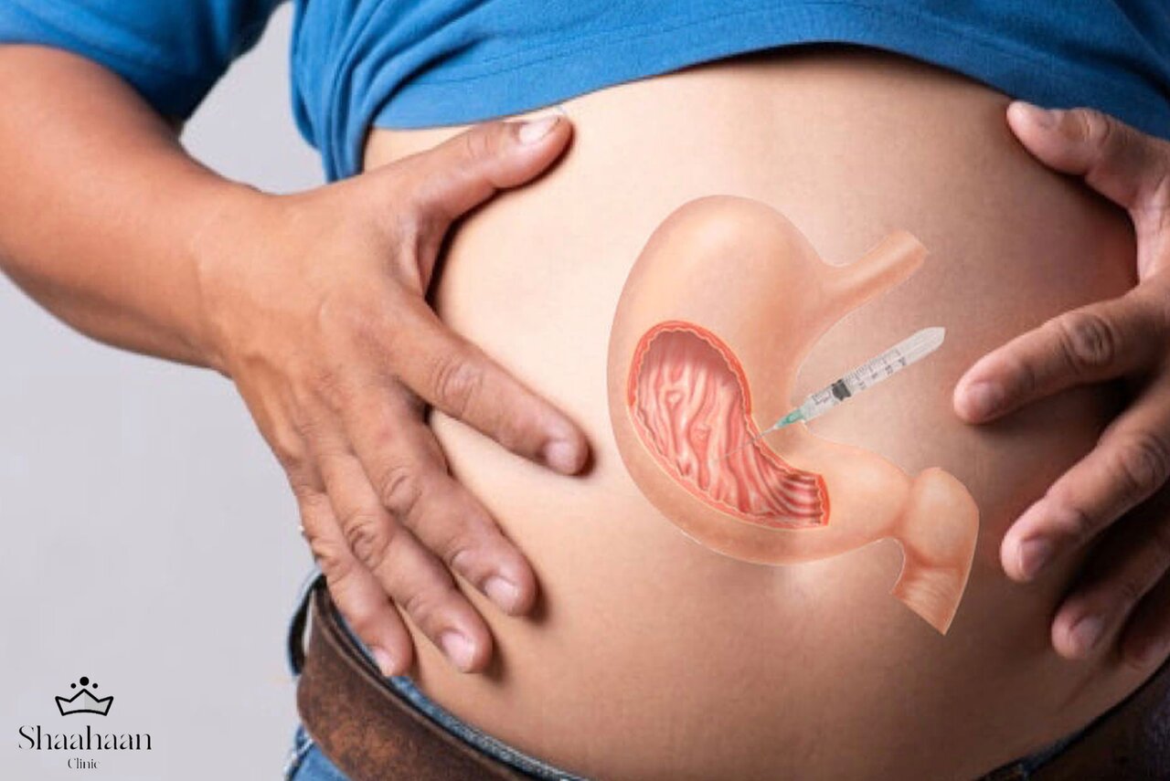 آیا بوتاکس معده برای شما مناسب است؟| هزینه بوتاکس معده