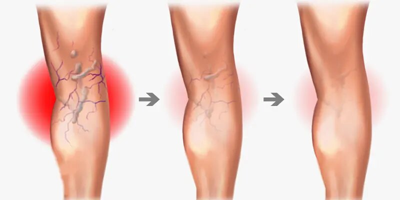 نشانههایی از زنگ خطر واریس و عوارض آن