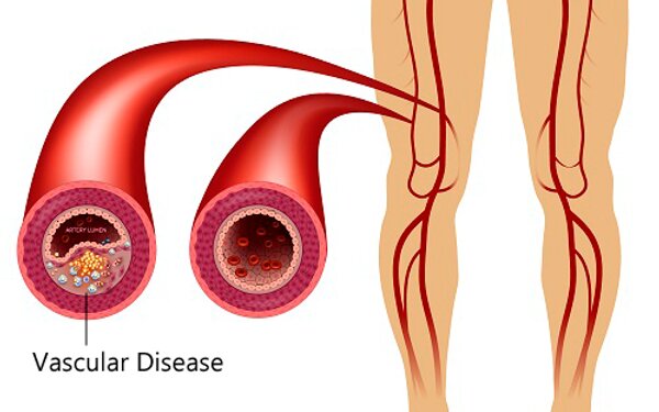 نشانههایی از زنگ خطر واریس و عوارض آن