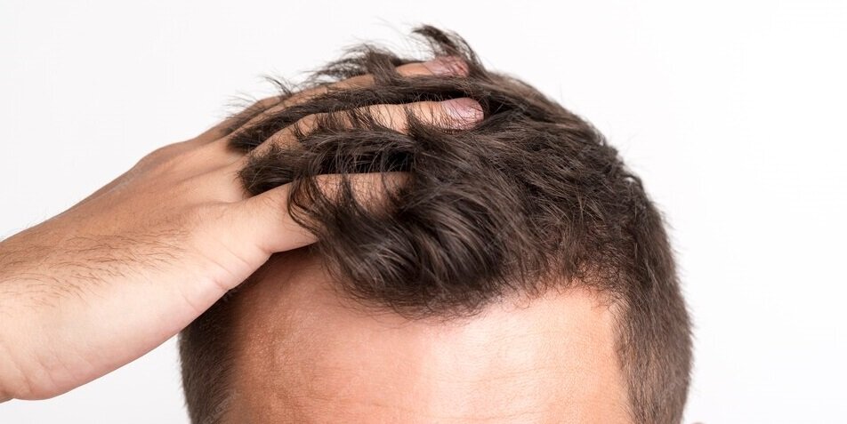 بهترین کلینیک کاشت مو در تهران