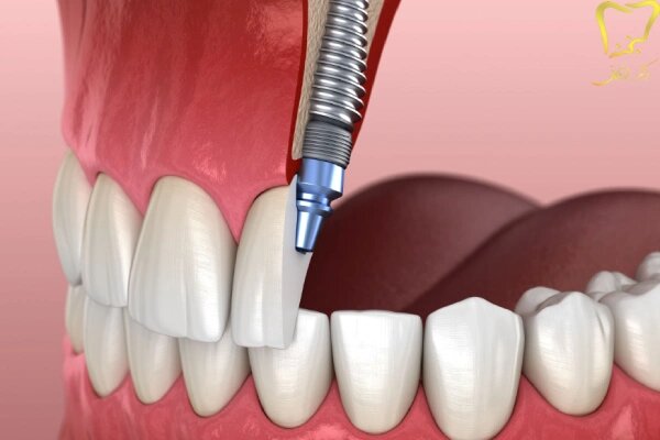 چه کسانی می توانند ایمپلنت کنند؟