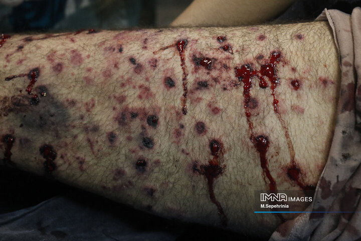 مصدومان شب چهارشنبه سوری