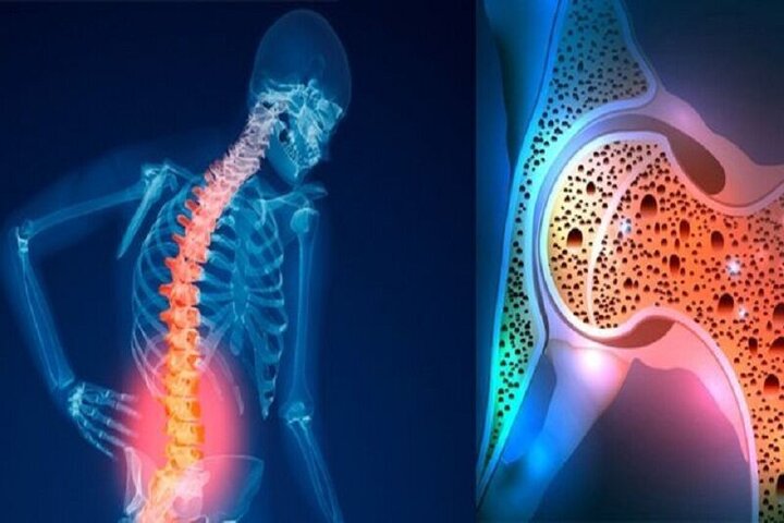 پوکی استخوان، چالش عمده سلامت عمومی پوکی استخوان، چالش عمده سلامت عمومی