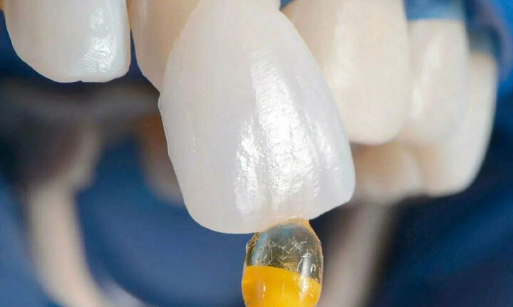 کامپوزیت یا لمینت؟ مشاوره با دندانپزشک زیبایی کامپوزیت یا لمینت؟ مشاوره با دندانپزشک زیبایی