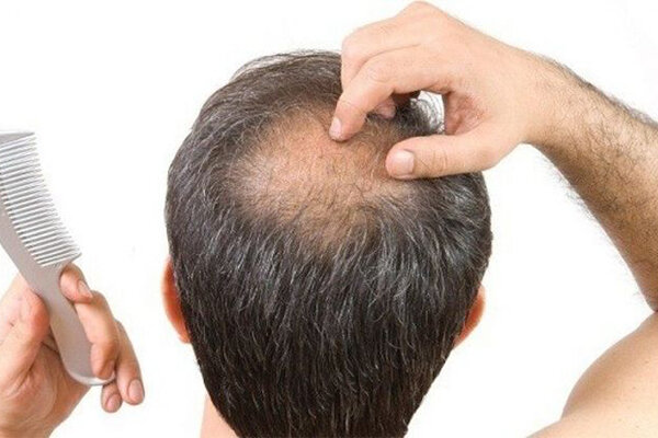 پرپشت شدن مو و جلوگیری از ریزش مو| چه قرصی مصرف کنیم؟ پرپشت شدن مو و جلوگیری از ریزش مو| چه قرصی مصرف کنیم؟