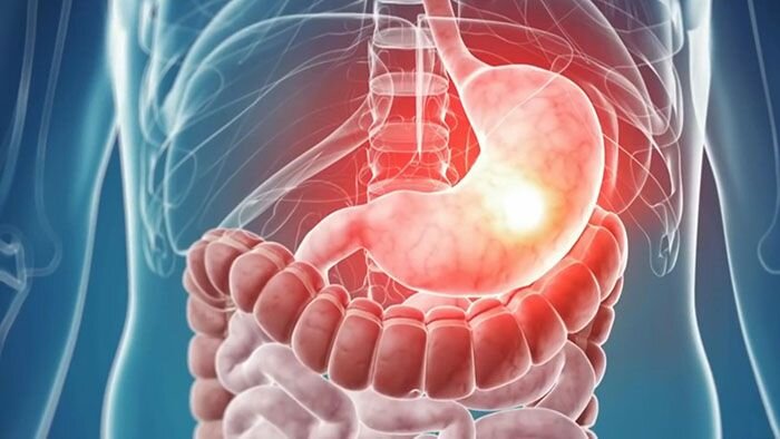 زنگ خطر علائم پنهان سرطان معده