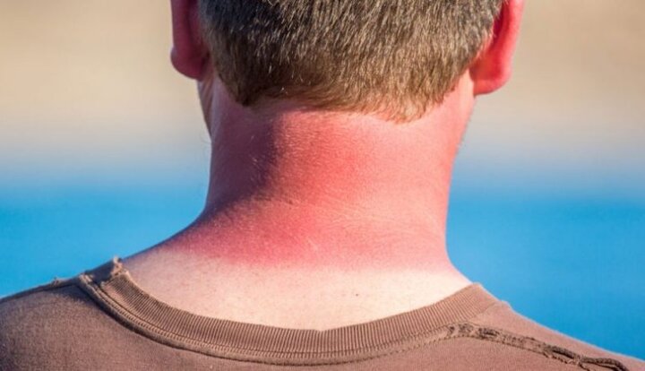 راهکارهای مراقبت از پوست و چشم در مقابله با تشعشعات خورشید