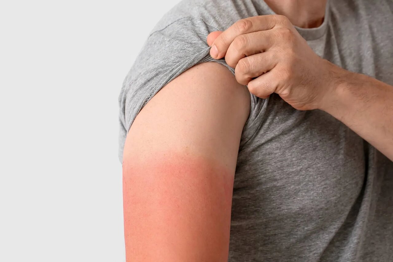 آفتاب سوختگی