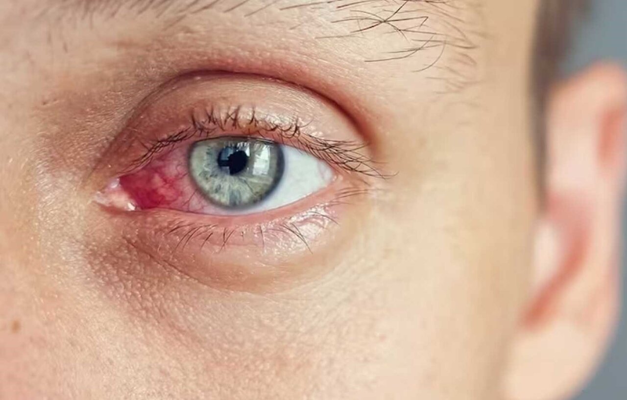 آلرژیهای چشمی؛ از تاثیر آلرژنها تا علائم بیماری
