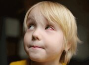 کارکرد چشم تحت تاثیر تحریک آلرژن‌ها