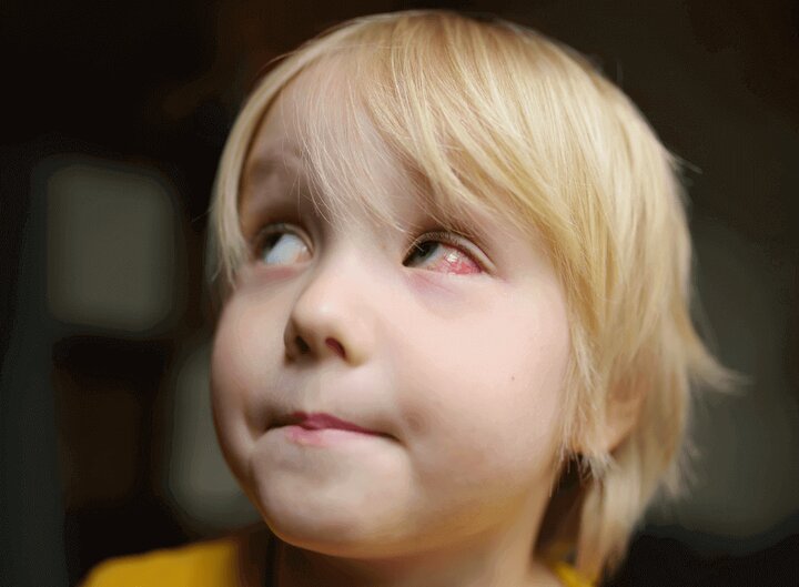 کارکرد چشم تحت تاثیر تحریک آلرژن‌ها