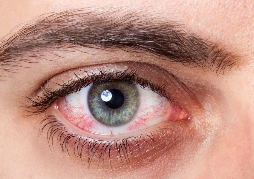 کارکرد چشم تحت تاثیر تحریک آلرژنها