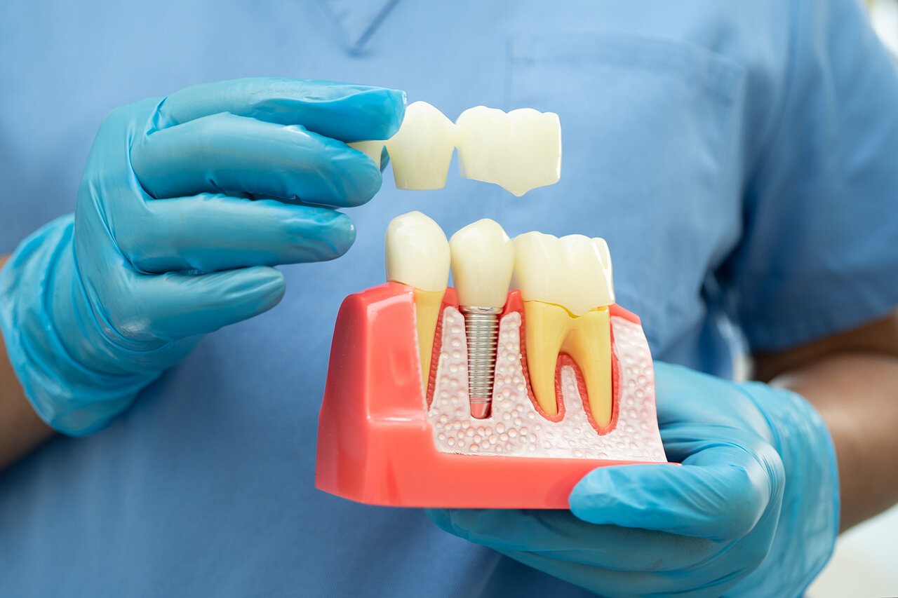 ایمپلنت دندان