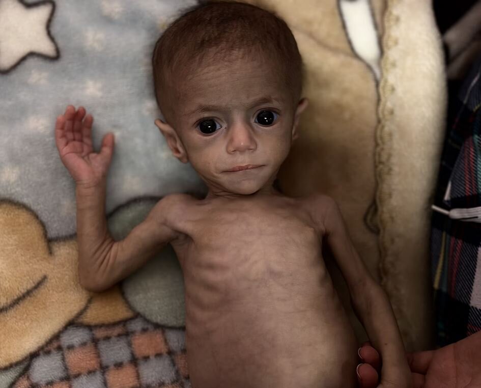 نوزادان غزه، جنگ را با پوست و استخوان میچشند