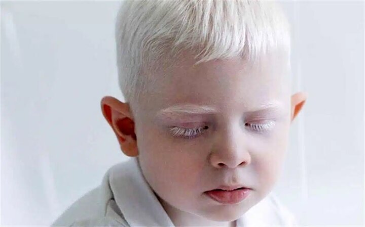 زالی چیست؟ + علائم، انواع و درمان آلبینیسم