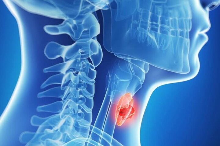 ۹۳ بیمار تیروئید در چهارمحال‌وبختیاری شناسایی شدند