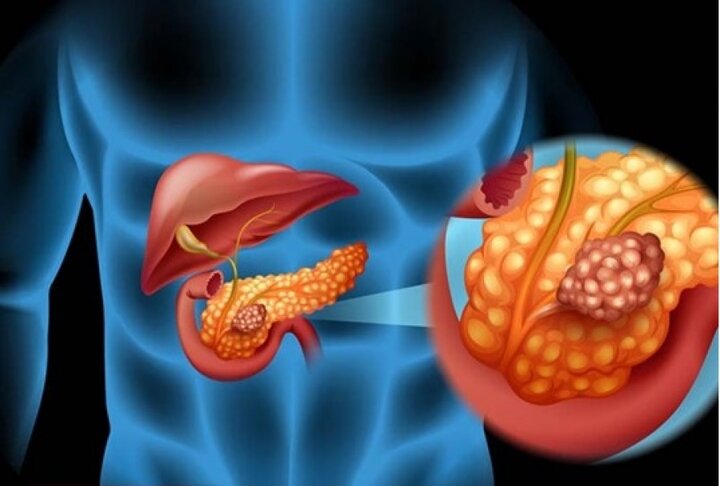 راهی نوین برای درمان سرطان لوزالمعده