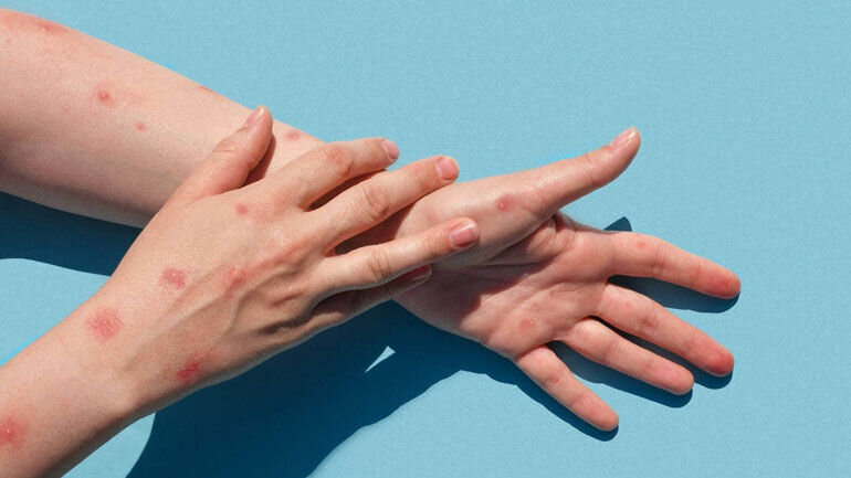 آبله مرغان و مراقبتهای آن