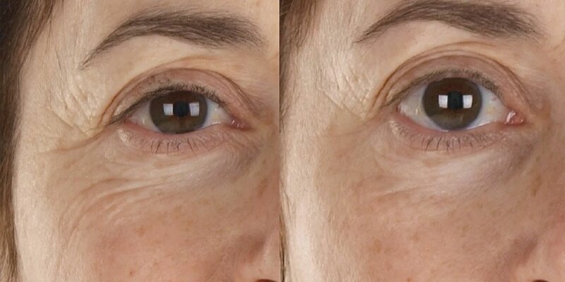 هایفو تراپی 