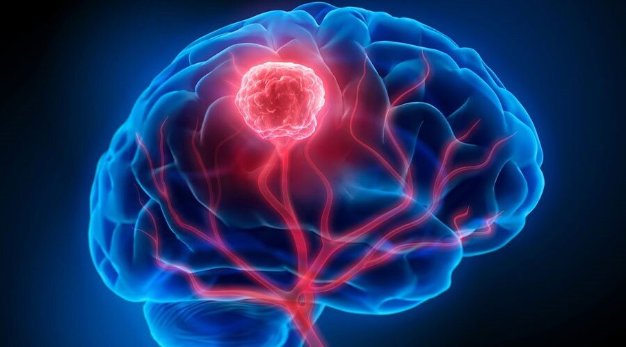 تومورهای مغزی؛ از ضرورت تشخیص زودهنگام تا دریافت درمان موثر