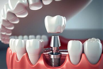 بررسی کامل قیمت ایمپلنت دندان در سال ۱۴۰۴