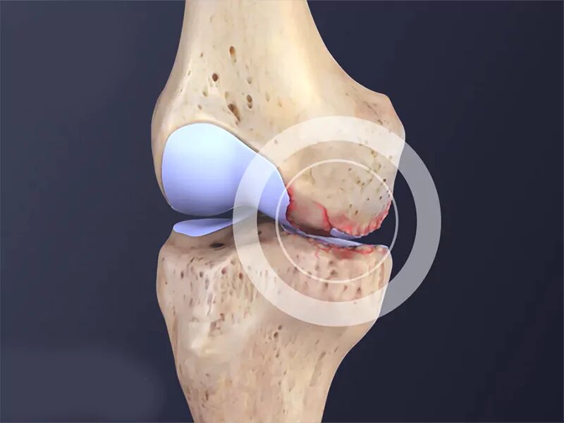 آرتروز زانو؛ از افزایش سن تا تاثیر سبک زندگی