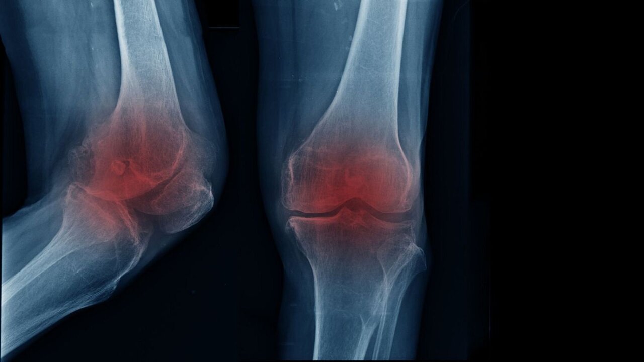 آرتروز زانو؛ از افزایش سن تا تاثیر سبک زندگی