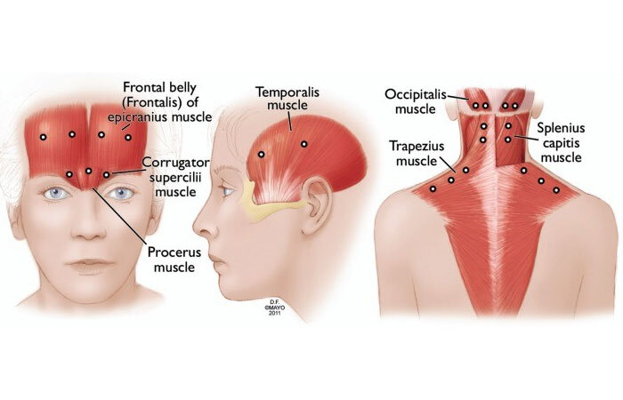 بوتاکس درمانی برای میگرن