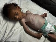 هشدار یونیسف درباره سوءتغذیه شدید ۱۳ هزار کودک در غزه