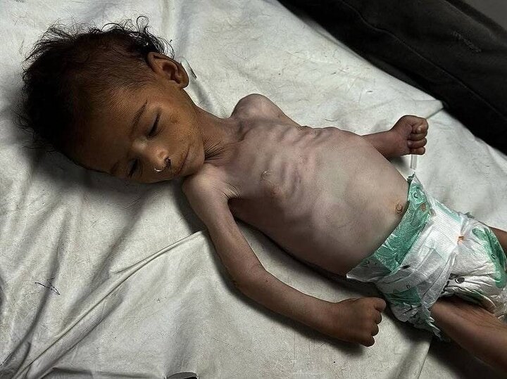 هشدار یونیسف درباره سوءتغذیه شدید ۱۳ هزار کودک در غزه