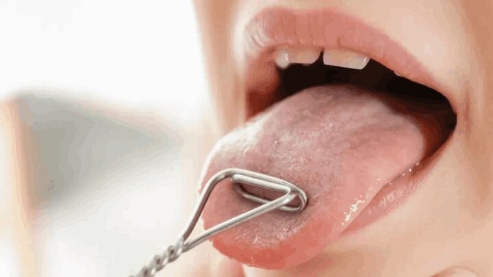 علائم هشداردهنده سرطان زبان چیست؟