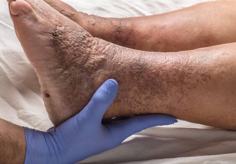 بیماری دونالد ترامپ چیست؟ | همه چیز درباره کبودی دست و وضعیت سلامت رئیسجمهور آمریکا