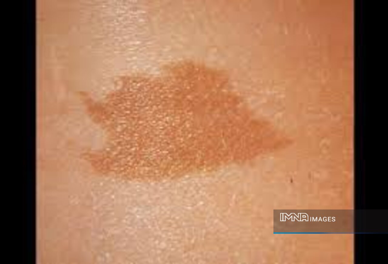 علت ماه گرفتگی روی بدن نوزاد چیست؟ | جلوگیری از ماه گرفتگی واقعی است؟